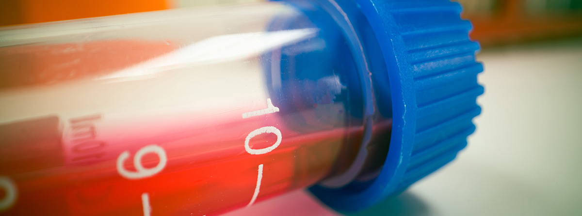 Leczenie krwawień u chorych na hemofilię A powikłaną inhibitorem otrzymujących emicizumab - zalecenia brytyjskie