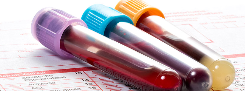 Testy laboratoryjne na obecność czynnika V Leiden oraz czynnika II c.*97G>A w diagnostyce żylnej choroby zakrzepowo-zatorowej - aktualne standardy ACMG