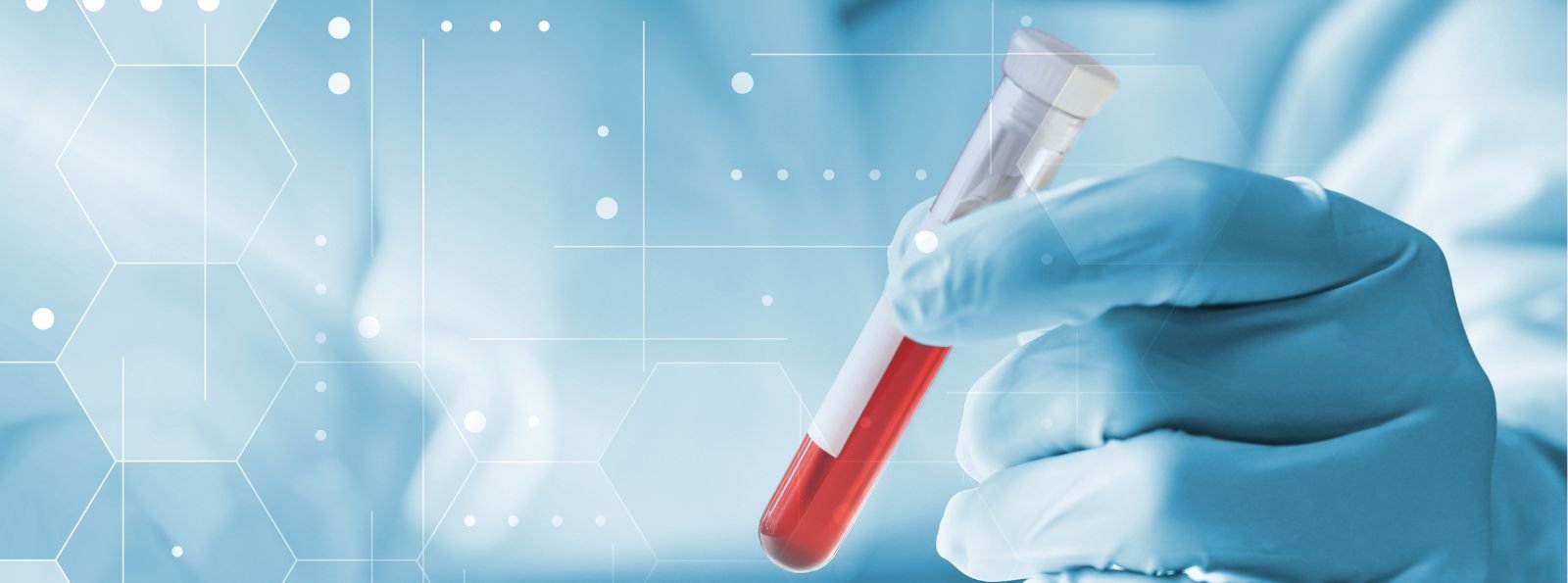 Leczenie hemofilii wymaga złożonych rozwiązań systemowych