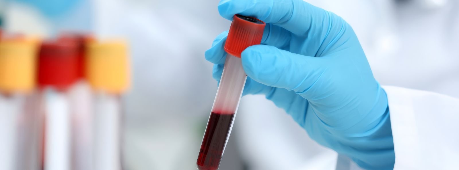 Skuteczność bezpośrednich doustnych leków przeciwkrzepliwych (DOAC) w porównaniu z warfaryną w zapobieganiu zatorowości systemowej u chorych z migotaniem przedsionków: meta-analiza indywidualnych danych, pochodzących z randomizowanych badań